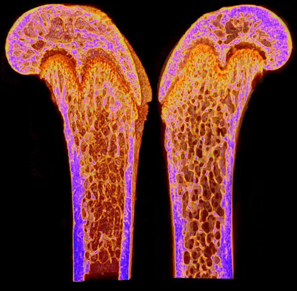 Problems with bone density